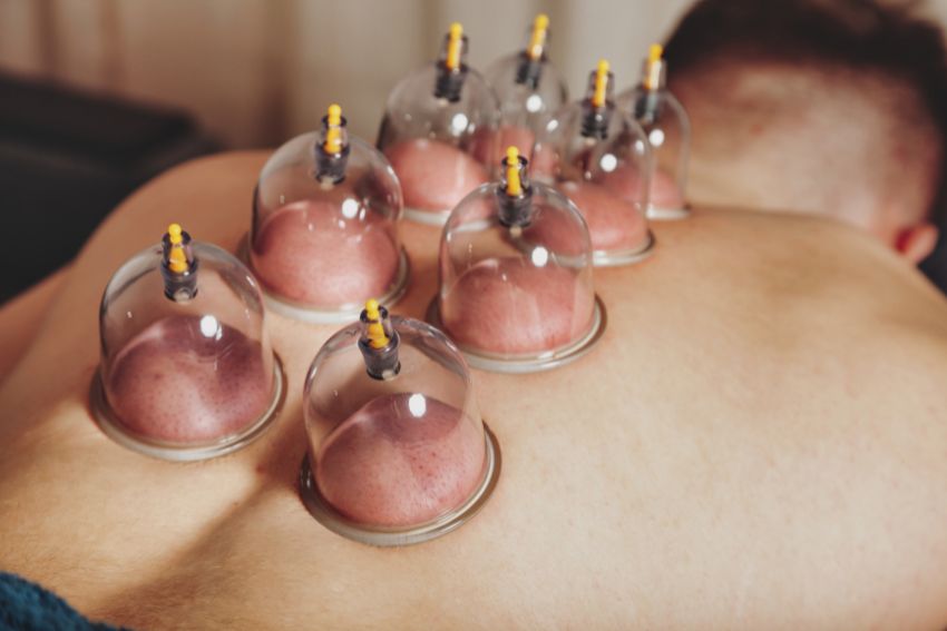 Cupping Therapy Services